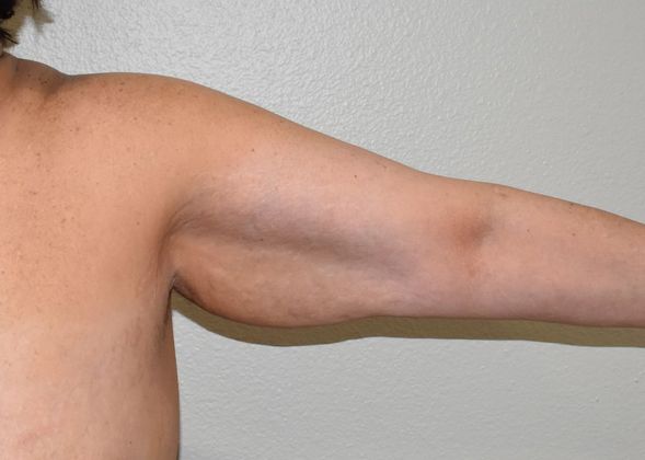 Brachioplasty Case 11 - Before