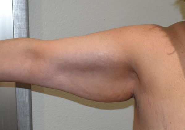 Brachioplasty: Case 11 - Before