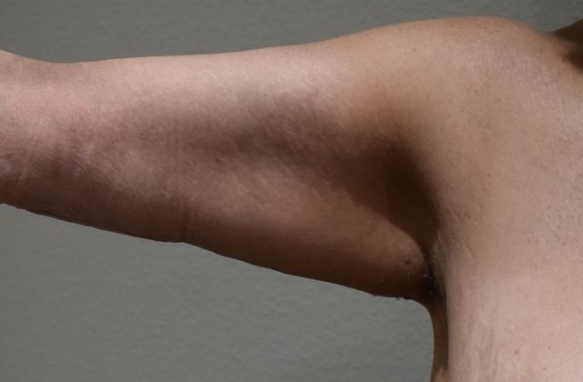 Brachioplasty: Case 11 - After