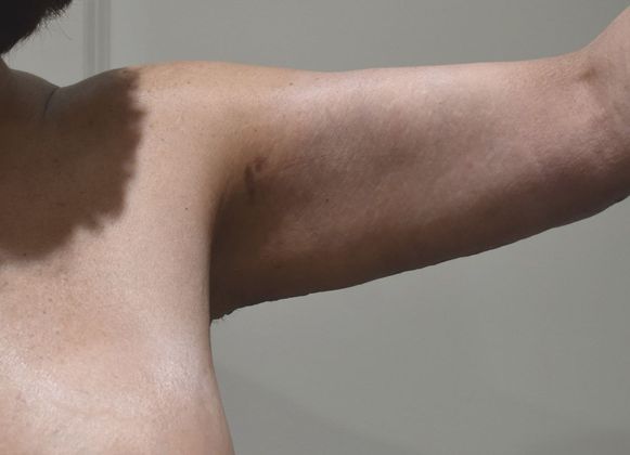Brachioplasty Case 11 - After