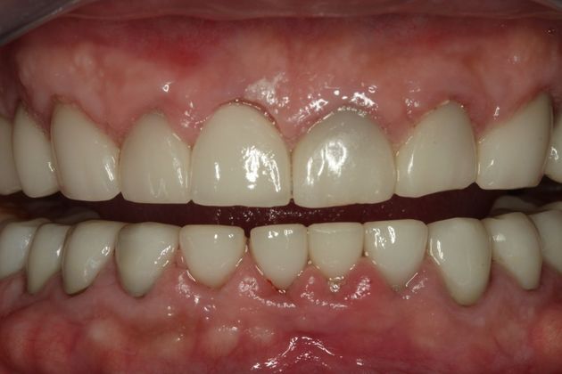 Cosmetic Dentistry: Cosmetic Dentistry - Case 3 - After