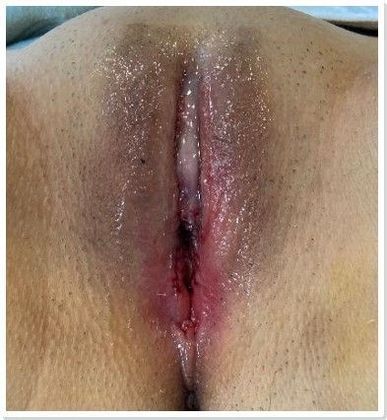 Labiaplasty Case 19 Labiaplasty, Darien, CT - After