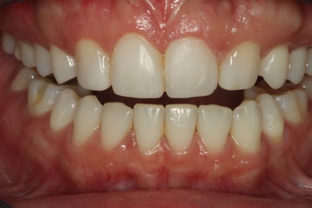 Composite Bonding: Case 3 - After
