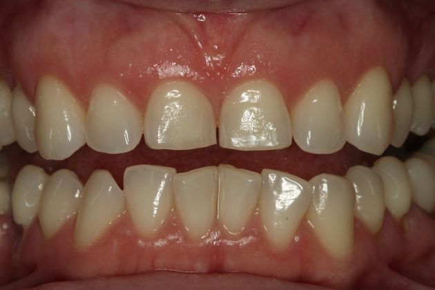 Composite Bonding: Case 4 - Before