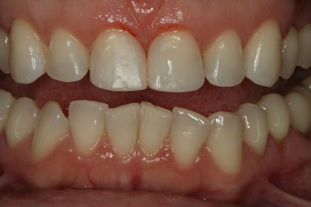 Composite Bonding: Case 4 - After