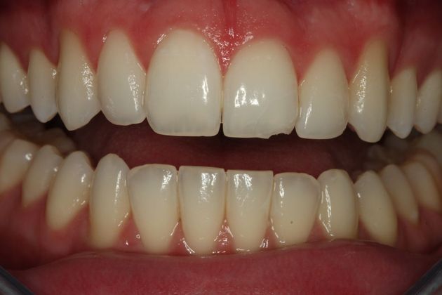 Composite Bonding Case 5 - Before