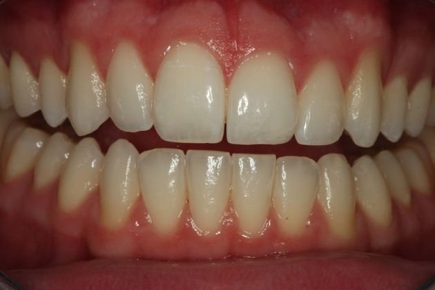 Composite Bonding Case 5 - After