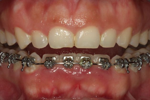 Composite Bonding: Case 6 - Before