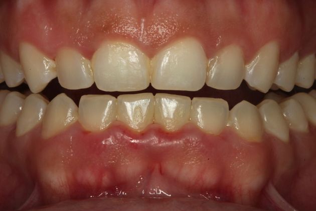 Composite Bonding: Case 6 - After