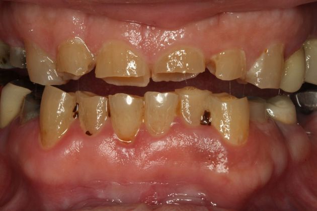 Composite Bonding: Case 7 - After