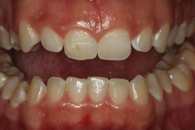 Laser Gum Reshaping Case 3 - Before