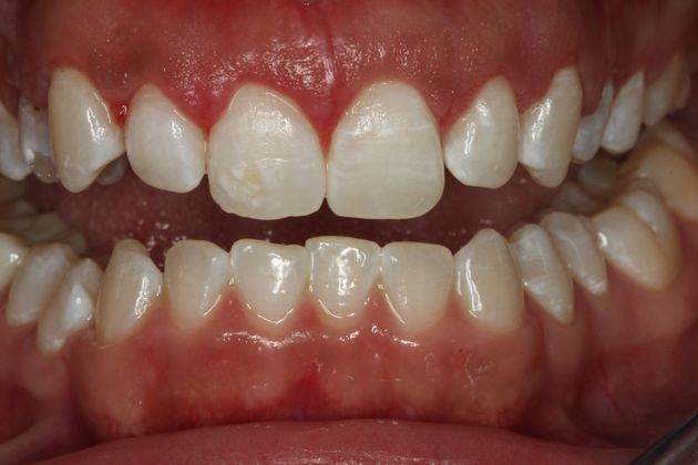 Laser Gum Reshaping Case 3 - After