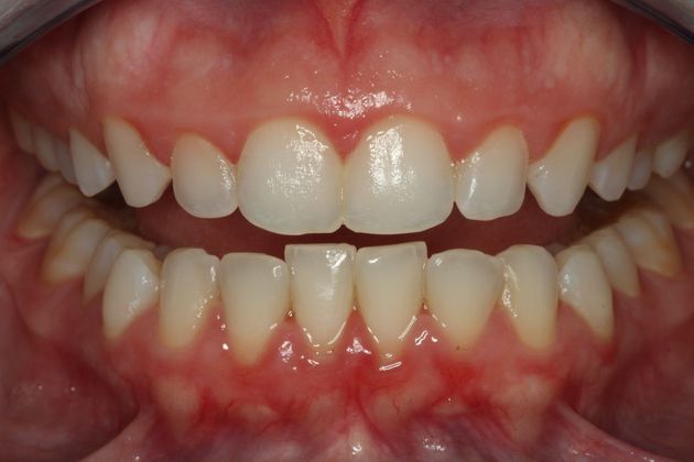 Laser Gum Reshaping Case 4 - Before