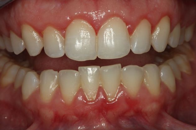 Laser Gum Reshaping Case 4 - After