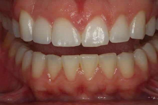 Laser Gum Reshaping Case 5 - Before