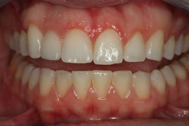 Laser Gum Reshaping Case 5 - After