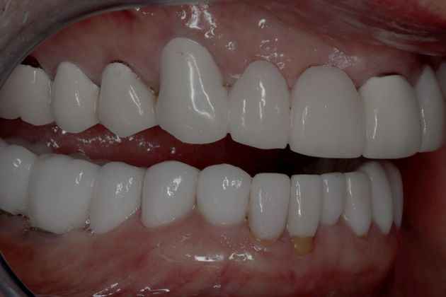 Dental Implants Case 3 - After