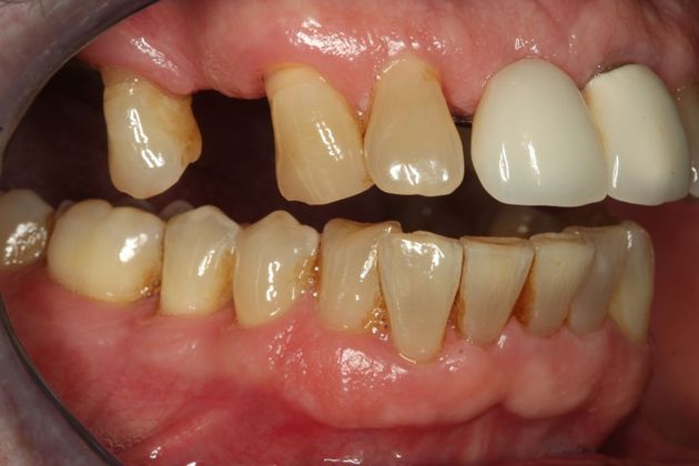 Dental Implants: Case 4 - Before