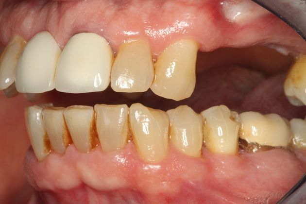 Dental Implants: Case 4 - Before