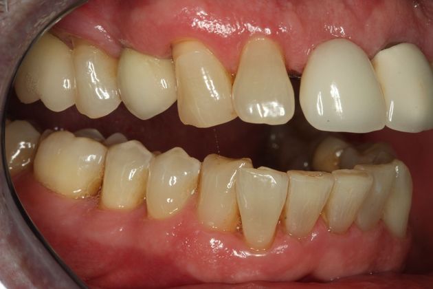 Dental Implants: Case 4 - After