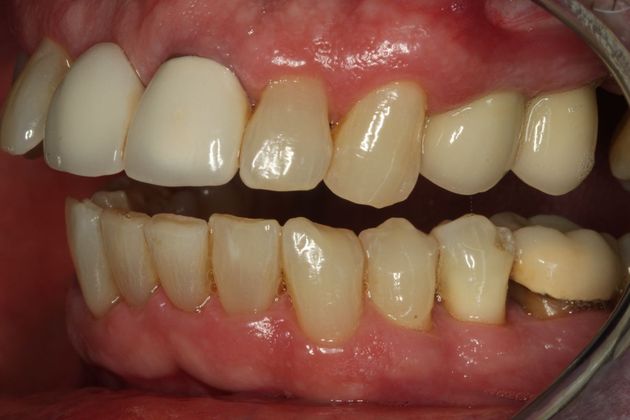 Dental Implants: Case 4 - After