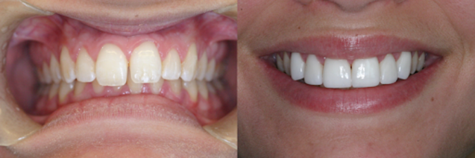 Cosmetic Dentistry Case 1