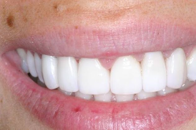 Cosmetic Dentistry Case 2 - After