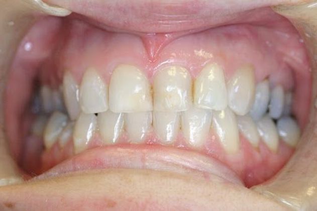 Cosmetic Dentistry Case 3 - Before