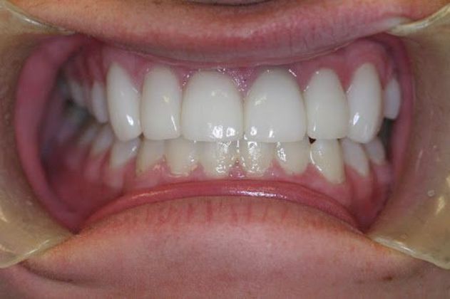 Cosmetic Dentistry Case 4 - After