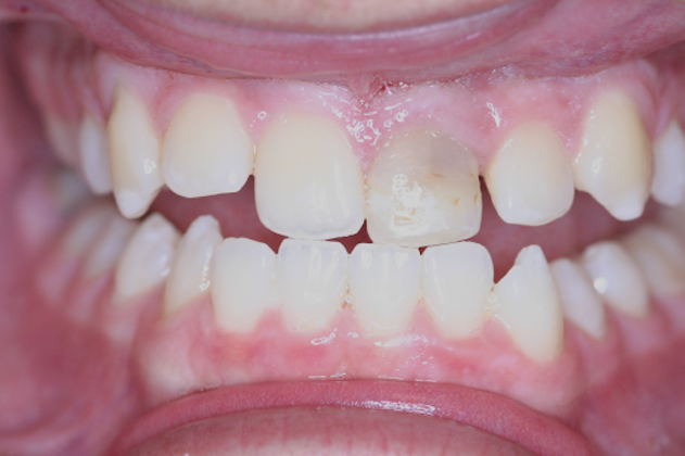 Cosmetic Dentistry Case 4 - Before