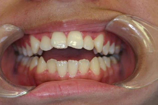 Orthodontics Case 2 - Before