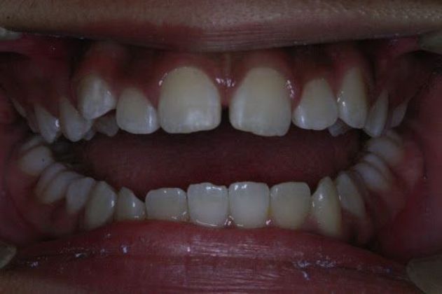 Orthodontics Case 3 - Before