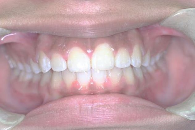 Orthodontics Case 3 - After