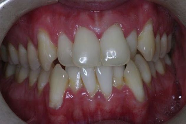 Orthodontics Case 4 - Before