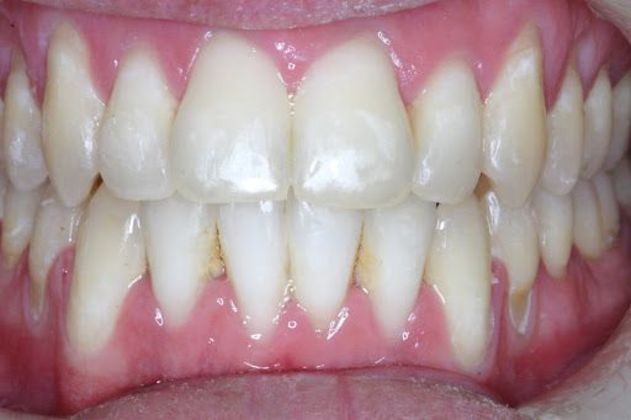 Orthodontics Case 4 - After