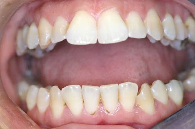 Orthodontics Case 5 - Before