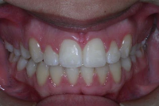 Orthodontics Case 6 - After