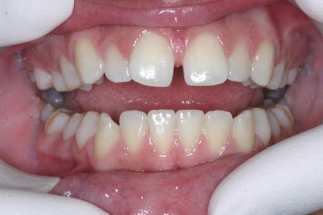 Orthodontics Case 6 - Before