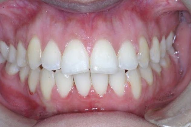 Orthodontics Case 7 - After