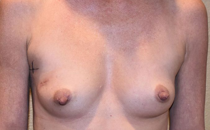 Breast Reconstruction Case 72 - Before