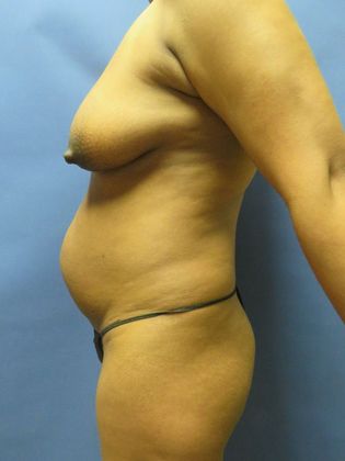 Mommy Makeover: Case 1 - Before