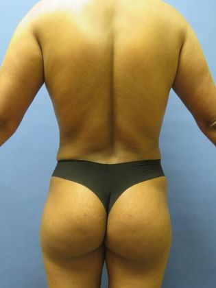 Brazilian Butt Lift Case 2 - After