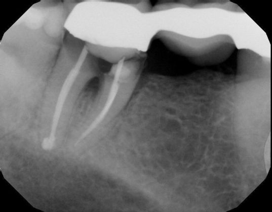 Dental Implants Case 39 - Before