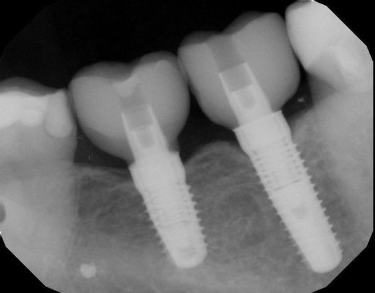 Dental Implants Case 39 - After