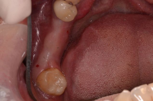 Dental Implants: Case 39 - After failing bridge is removed and before implants are placed.