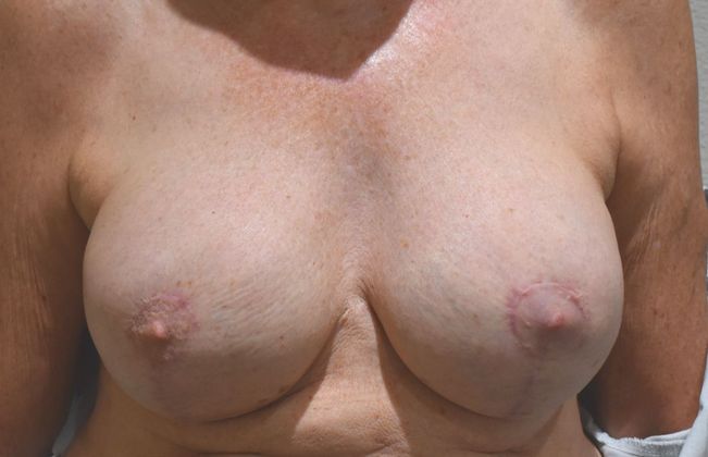Breast Augmentation w/ Lift Case 333 - After