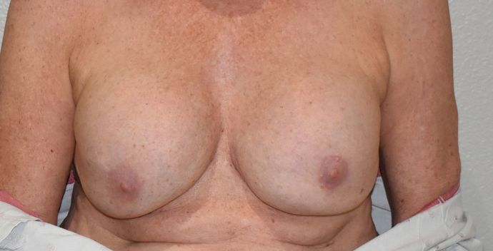 Breast Augmentation w/ Lift Case 333 - Before