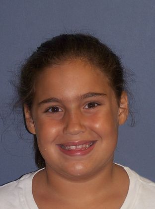 Amazing Smiles: Correct Gaps and Spacing - Before