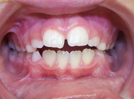 Amazing Smiles: Correct Gaps and Spacing - Before