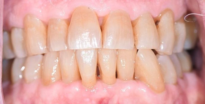 Periodontal Cleaning Case 8 - Cuero, TX - After